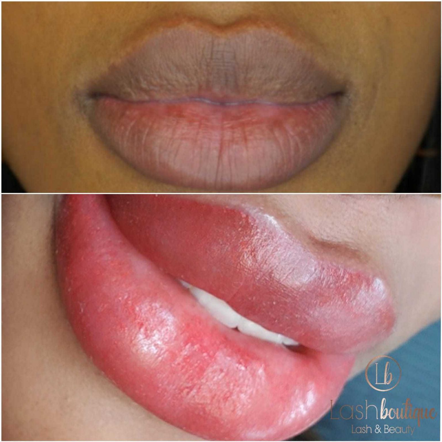 how-do-i-get-rid-of-severely-chapped-lips-in-2020-chapped-lips-sore